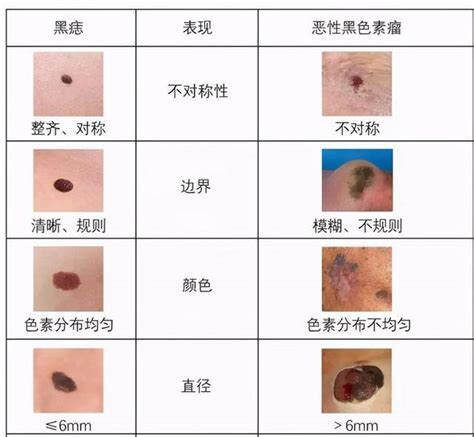 痣的形成原因|痣（黑素细胞痣）